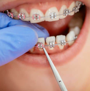 Orthodontic Treatment