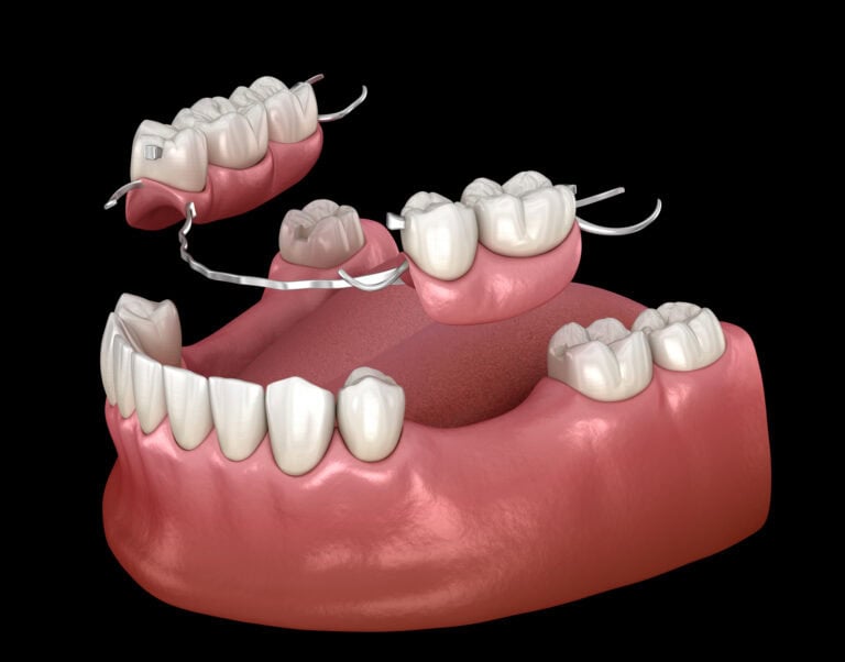 Partial and Full Dentures