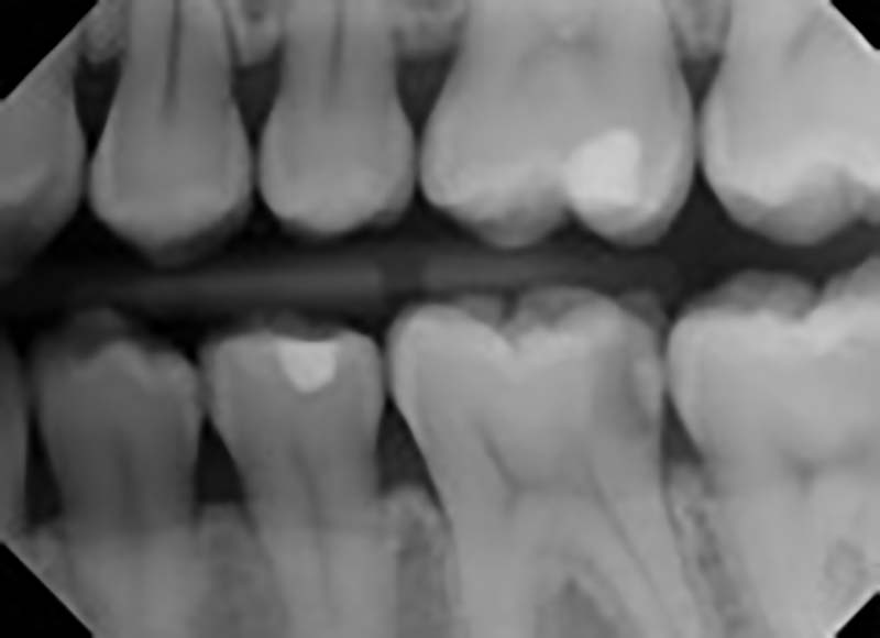 Dental X-ray