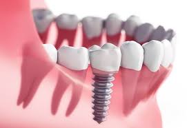 Dental Implants : What are dental implants ? advantages and disadvantages.